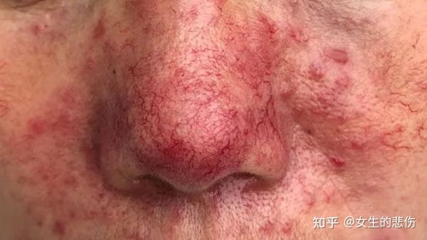 草莓鼻是什么？插图