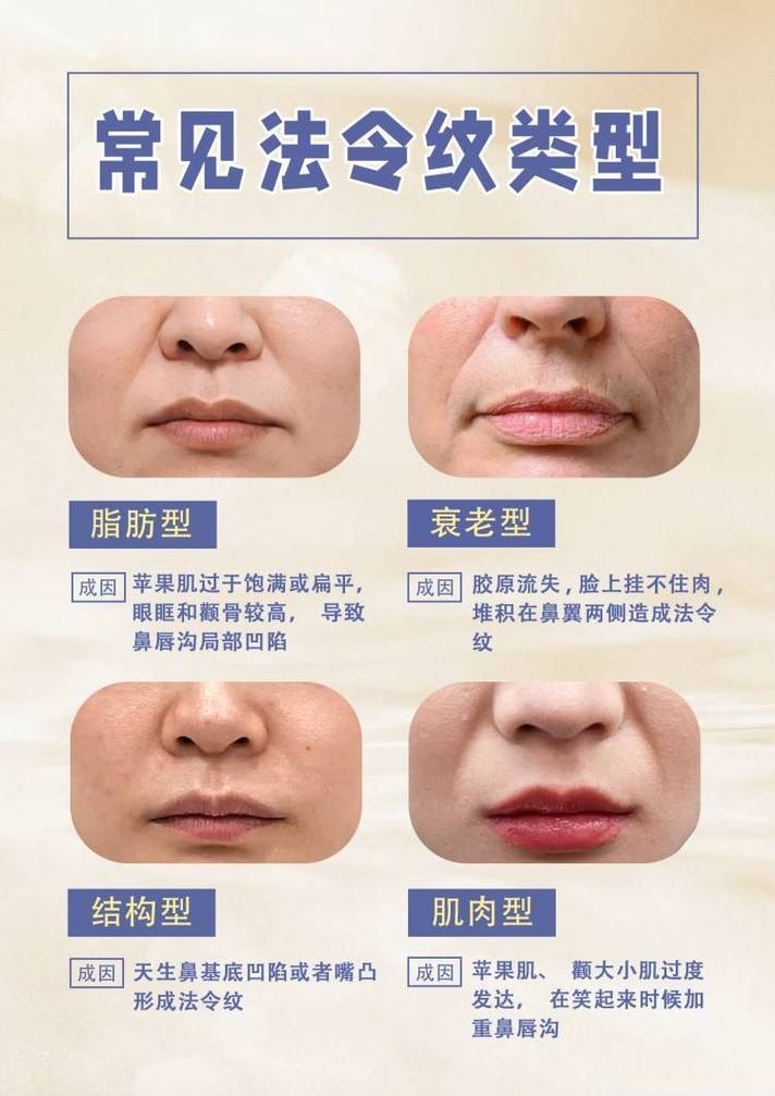 法令纹入口，解锁面部美学的秘密插图