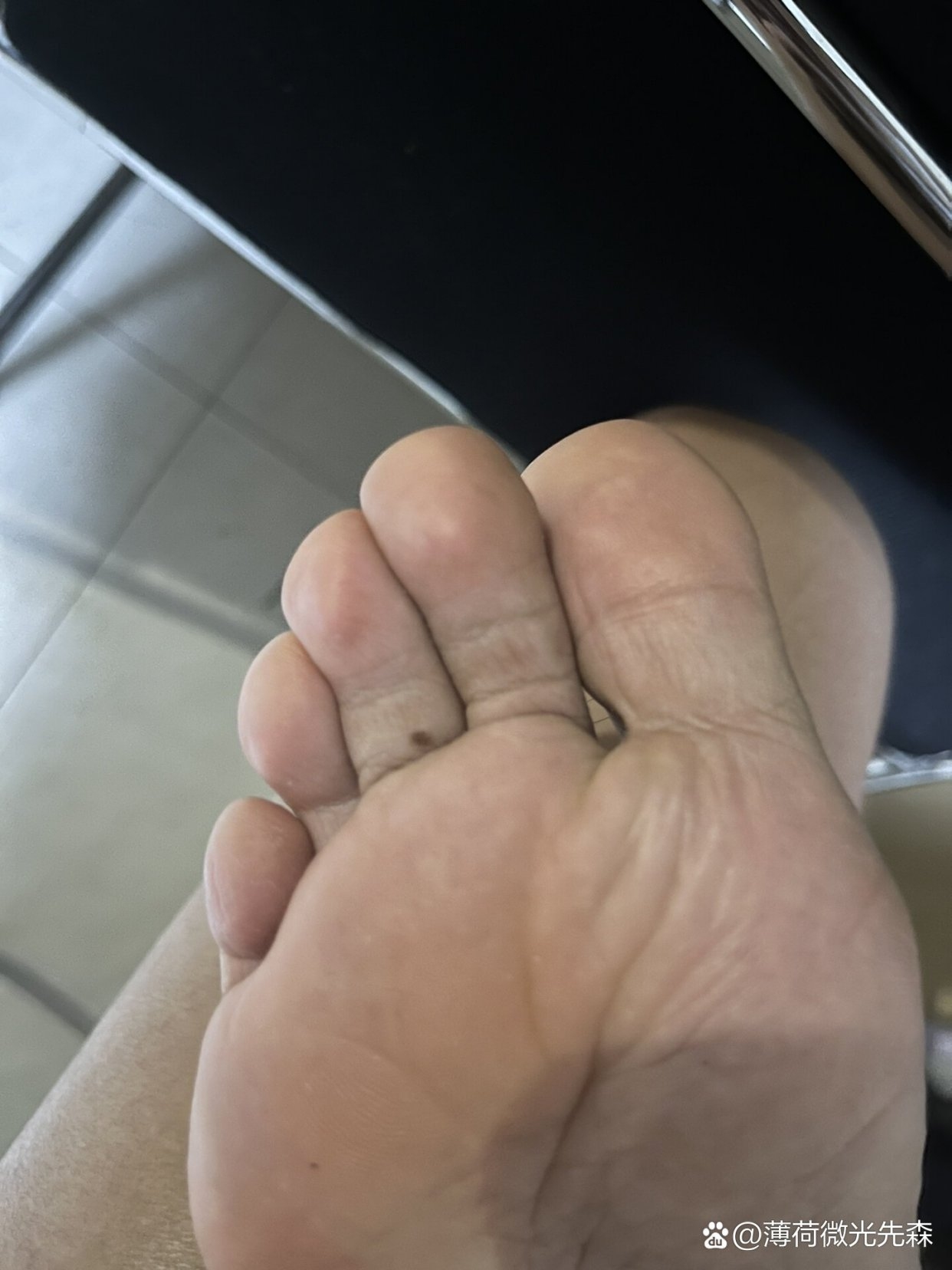 脚底有痣？你真的需要警惕吗？插图