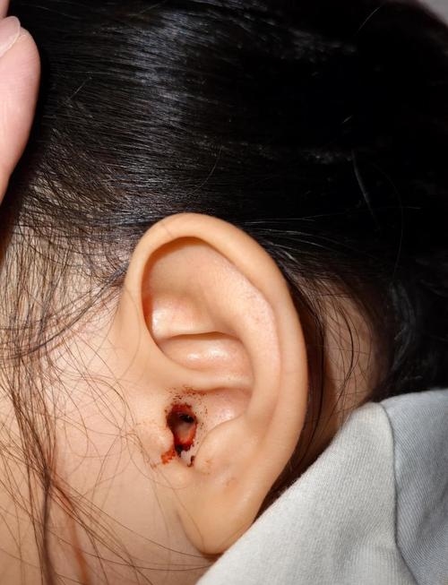 梦见耳朵出血，情何以堪？插图