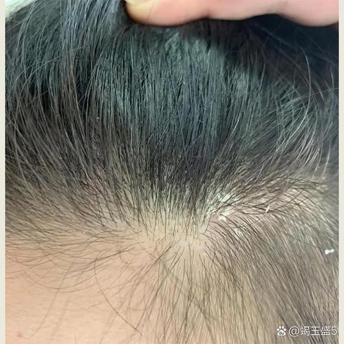 梦中的头皮屑之谜插图