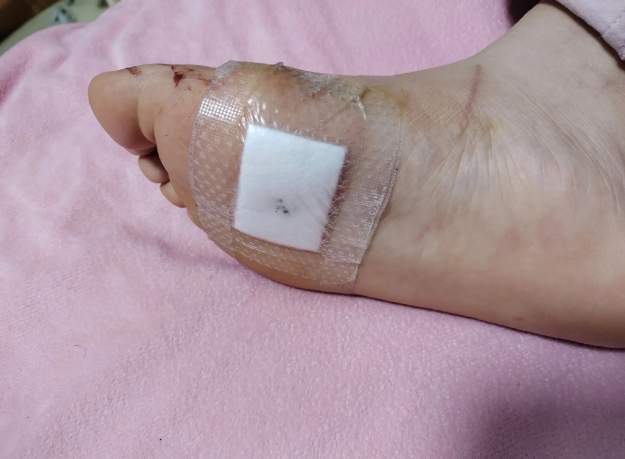 右脚脚底有痣，探寻健康秘密插图