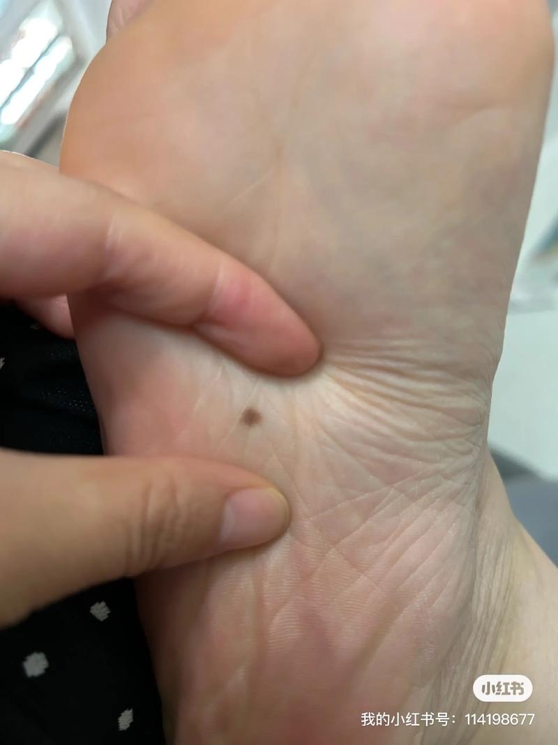 男人右脚底有痣，命运的神秘印记插图