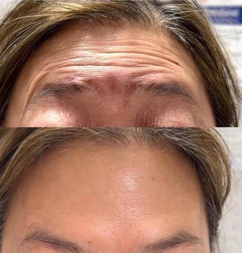 抬头纹，美与健康的双重考量插图