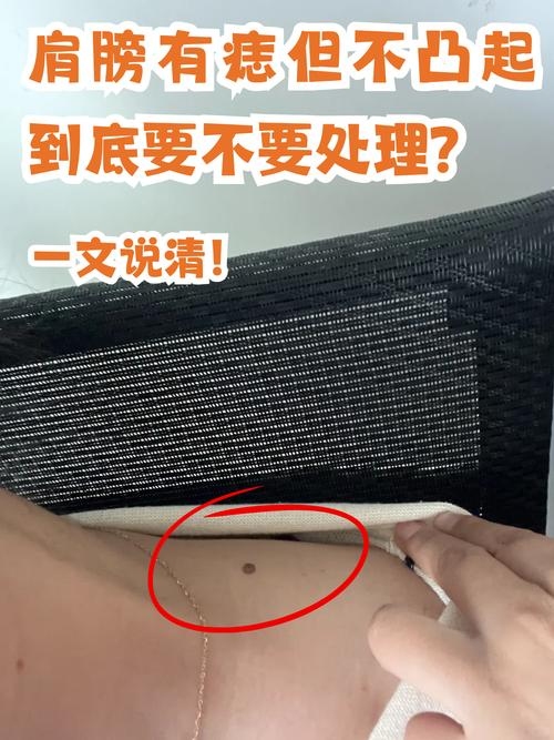 肩膀上有痣，命运的预兆还是命运的印记？插图