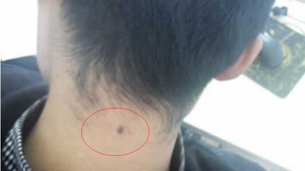 脖子后面的神秘印记—苦情痣插图