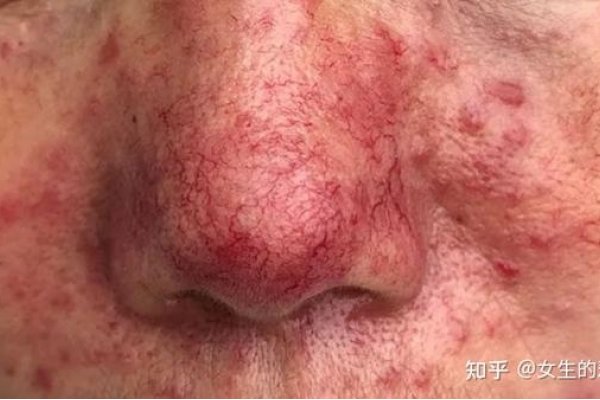 草莓鼻是什么？-新乐天