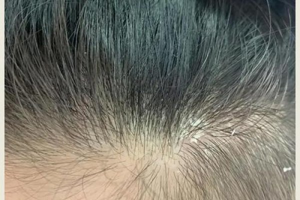 梦中的头皮屑之谜-新乐天