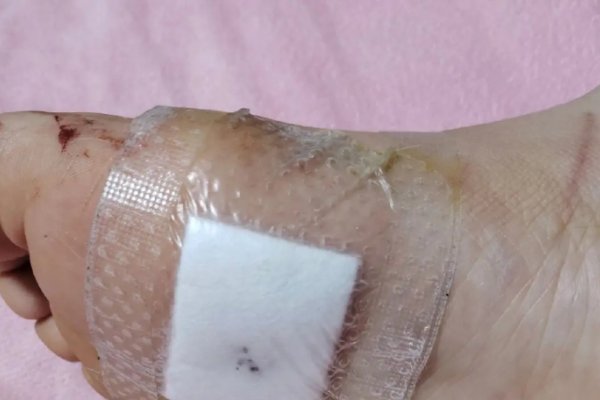 右脚脚底有痣，探寻健康秘密-新乐天