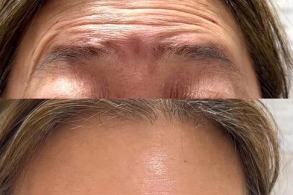 抬头纹，美与健康的双重考量-新乐天