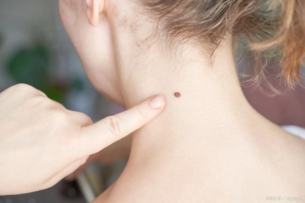 脖子后面有痣的人，一种独特的标记-新乐天