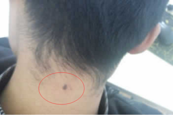 脖子后面的神秘印记—苦情痣-新乐天